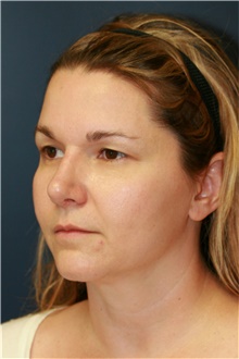 Rhinoplasty After Photo by Steve Laverson, MD, FACS; Rancho Santa Fe, CA - Case 40066