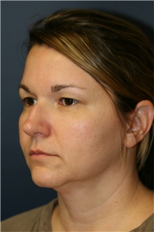 Rhinoplasty Before Photo by Steve Laverson, MD, FACS; Rancho Santa Fe, CA - Case 40066