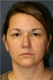 Rhinoplasty Before Photo by Steve Laverson, MD, FACS; Rancho Santa Fe, CA - Case 40066