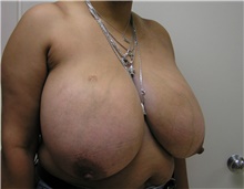Breast Reduction Before Photo by Steve Laverson, MD, FACS; San Diego, CA - Case 40070