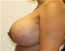 Breast Reduction After Photo by Steve Laverson, MD, FACS; Rancho Santa Fe, CA - Case 40070