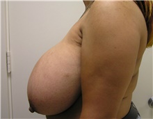 Breast Reduction Before Photo by Steve Laverson, MD, FACS; Rancho Santa Fe, CA - Case 40070