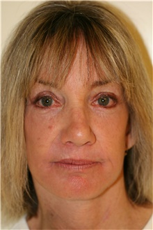 Facelift After Photo by Steve Laverson, MD, FACS; San Diego, CA - Case 40078