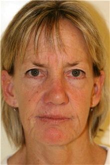 Facelift Before Photo by Steve Laverson, MD, FACS; San Diego, CA - Case 40078
