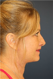 Facelift After Photo by Steve Laverson, MD, FACS; Rancho Santa Fe, CA - Case 40079