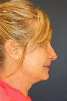 Facelift Before Photo by Steve Laverson, MD, FACS; Rancho Santa Fe, CA - Case 40079