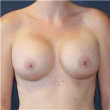 Breast Augmentation After Photo by Steve Laverson, MD, FACS; Rancho Santa Fe, CA - Case 40095