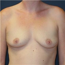 Breast Augmentation Before Photo by Steve Laverson, MD, FACS; Rancho Santa Fe, CA - Case 40095