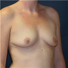 Breast Augmentation Before Photo by Steve Laverson, MD, FACS; Rancho Santa Fe, CA - Case 40095