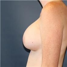 Breast Augmentation After Photo by Steve Laverson, MD, FACS; Rancho Santa Fe, CA - Case 40095