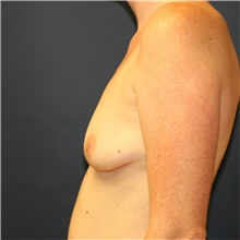 Breast Augmentation Before Photo by Steve Laverson, MD, FACS; Rancho Santa Fe, CA - Case 40095