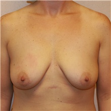 Breast Augmentation Before Photo by Steve Laverson, MD, FACS; Rancho Santa Fe, CA - Case 40112