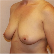 Breast Augmentation Before Photo by Steve Laverson, MD, FACS; Rancho Santa Fe, CA - Case 40112