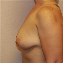 Breast Augmentation Before Photo by Steve Laverson, MD, FACS; Rancho Santa Fe, CA - Case 40112