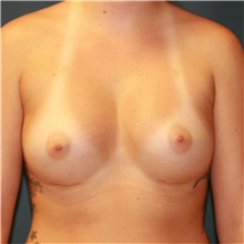 Breast Augmentation After Photo by Steve Laverson, MD, FACS; Rancho Santa Fe, CA - Case 40113