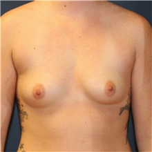 Breast Augmentation Before Photo by Steve Laverson, MD, FACS; Rancho Santa Fe, CA - Case 40113