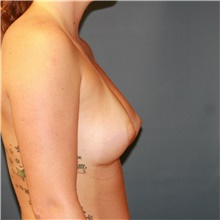 Breast Augmentation After Photo by Steve Laverson, MD, FACS; Rancho Santa Fe, CA - Case 40113