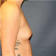 Breast Augmentation Before Photo by Steve Laverson, MD, FACS; Rancho Santa Fe, CA - Case 40113