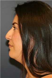 Rhinoplasty Before Photo by Steve Laverson, MD, FACS; Rancho Santa Fe, CA - Case 40178