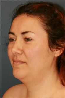 Rhinoplasty After Photo by Steve Laverson, MD, FACS; Rancho Santa Fe, CA - Case 40178