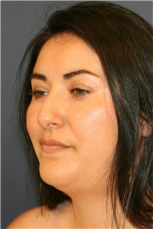 Rhinoplasty Before Photo by Steve Laverson, MD, FACS; Rancho Santa Fe, CA - Case 40178