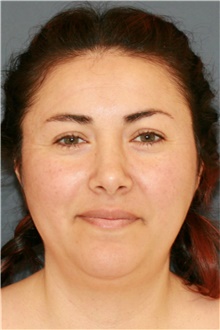 Rhinoplasty After Photo by Steve Laverson, MD, FACS; Rancho Santa Fe, CA - Case 40178