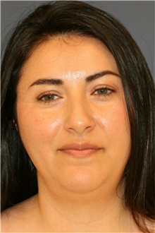 Rhinoplasty Before Photo by Steve Laverson, MD, FACS; Rancho Santa Fe, CA - Case 40178