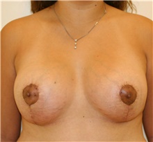 Breast Lift After Photo by Steve Laverson, MD; San Diego, CA - Case 40335
