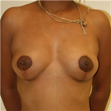 Breast Lift After Photo by Steve Laverson, MD, FACS; San Diego, CA - Case 40336