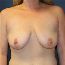 Breast Lift Before Photo by Steve Laverson, MD, FACS; Rancho Santa Fe, CA - Case 40352