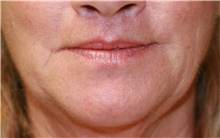 Lip Augmentation/Enhancement After Photo by Steve Laverson, MD, FACS; Rancho Santa Fe, CA - Case 40361