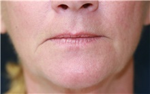 Lip Augmentation/Enhancement Before Photo by Steve Laverson, MD, FACS; Rancho Santa Fe, CA - Case 40361