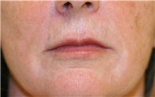 Lip Augmentation/Enhancement Before Photo by Steve Laverson, MD, FACS; Rancho Santa Fe, CA - Case 40363