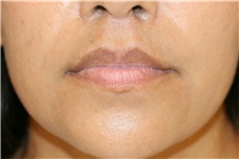 Lip Augmentation/Enhancement After Photo by Steve Laverson, MD, FACS; Rancho Santa Fe, CA - Case 40373