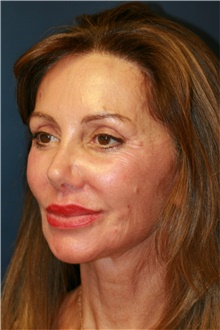 Facelift Before Photo by Steve Laverson, MD; San Diego, CA - Case 40392