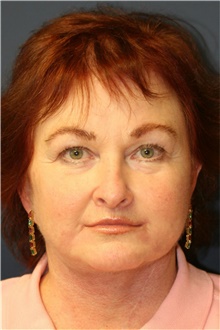 Facelift After Photo by Steve Laverson, MD, FACS; San Diego, CA - Case 40394