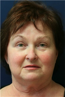 Facelift Before Photo by Steve Laverson, MD, FACS; San Diego, CA - Case 40394