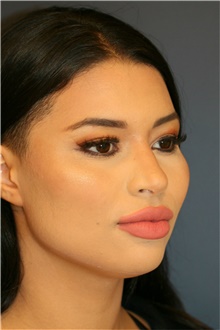 Rhinoplasty After Photo by Steve Laverson, MD, FACS; Rancho Santa Fe, CA - Case 40400