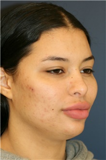 Rhinoplasty Before Photo by Steve Laverson, MD, FACS; Rancho Santa Fe, CA - Case 40400