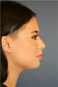 Rhinoplasty After Photo by Steve Laverson, MD, FACS; Rancho Santa Fe, CA - Case 40400