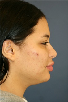 Rhinoplasty Before Photo by Steve Laverson, MD, FACS; Rancho Santa Fe, CA - Case 40400