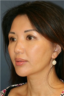 Chin Augmentation After Photo by Steve Laverson, MD, FACS; San Diego, CA - Case 40412