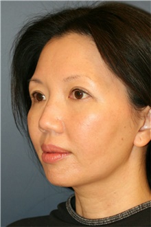 Chin Augmentation Before Photo by Steve Laverson, MD, FACS; Rancho Santa Fe, CA - Case 40412