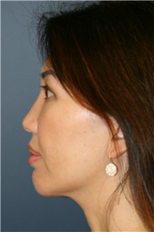 Chin Augmentation After Photo by Steve Laverson, MD, FACS; San Diego, CA - Case 40412