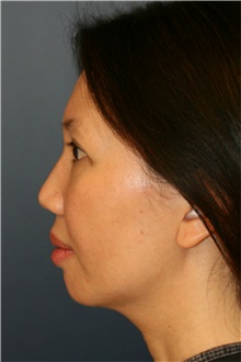 Chin Augmentation Before Photo by Steve Laverson, MD, FACS; San Diego, CA - Case 40412