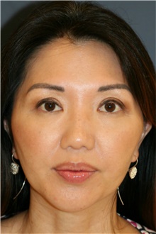 Chin Augmentation After Photo by Steve Laverson, MD, FACS; San Diego, CA - Case 40412