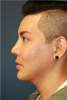 Chin Augmentation After Photo by Steve Laverson, MD, FACS; Rancho Santa Fe, CA - Case 40414