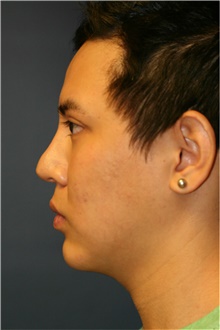 Chin Augmentation Before Photo by Steve Laverson, MD; San Diego, CA - Case 40414