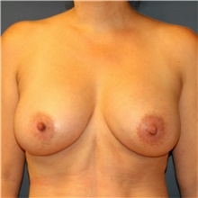 Breast Augmentation After Photo by Steve Laverson, MD, FACS; San Diego, CA - Case 40427