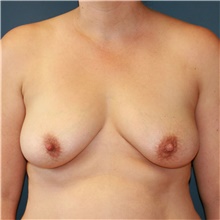Breast Augmentation Before Photo by Steve Laverson, MD, FACS; San Diego, CA - Case 40427